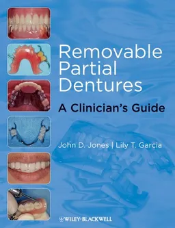 Removable Partial Dentures: A Clinician's Guide (Restorative Dentistry)