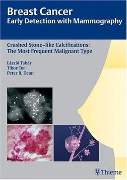 Crushed Stone-like Calcifications: The Most Frequent Malignant Type (Breast Cancer - Early Detection with Mammography)